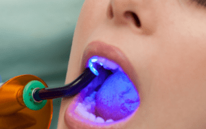 diferencias entre empaste y reconstrucción dental