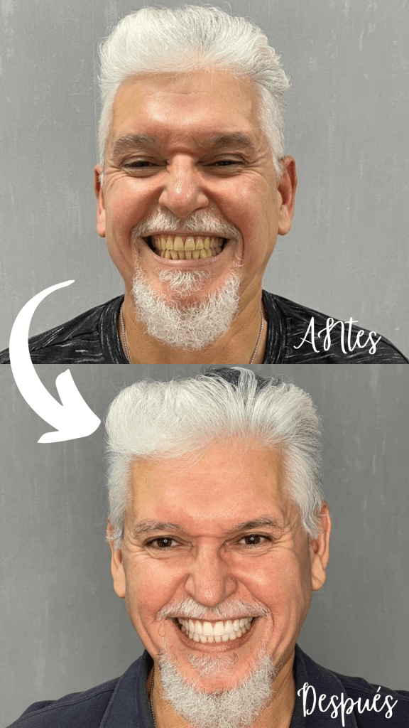 blanqueamiento antes y después