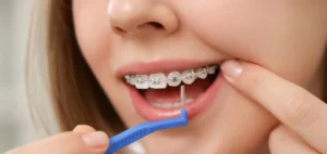 Cómo cuidar los dientes con brackets