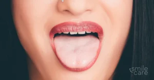 Mujer muestra la lengua blanca por boca seca