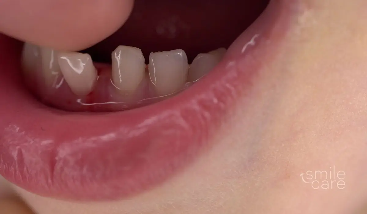 Dientes que se mueven o se aflojan en adultos