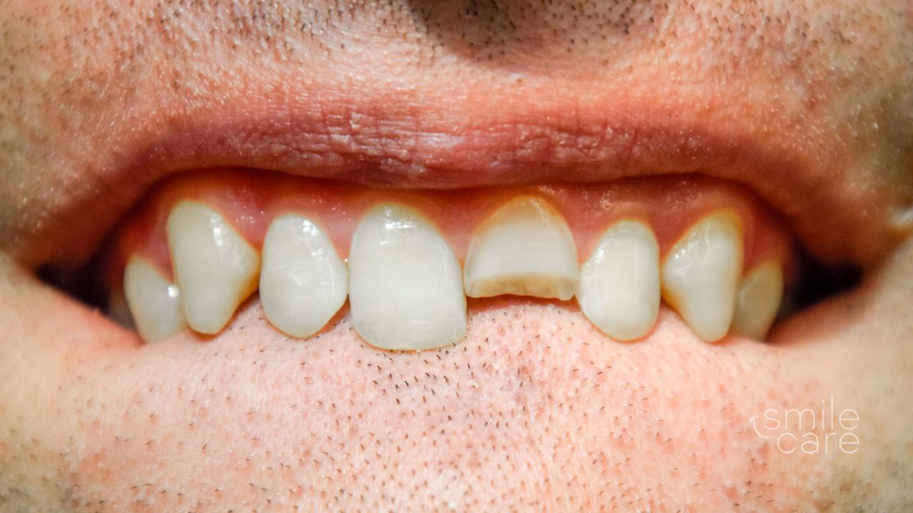 Detalle de una boca con un diente roto
